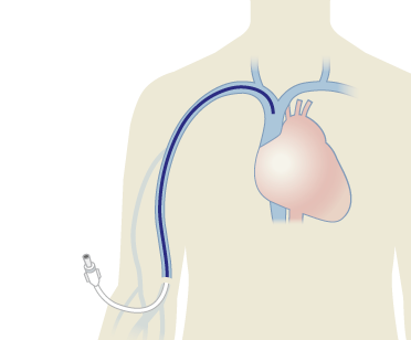 tegning af PICC-line