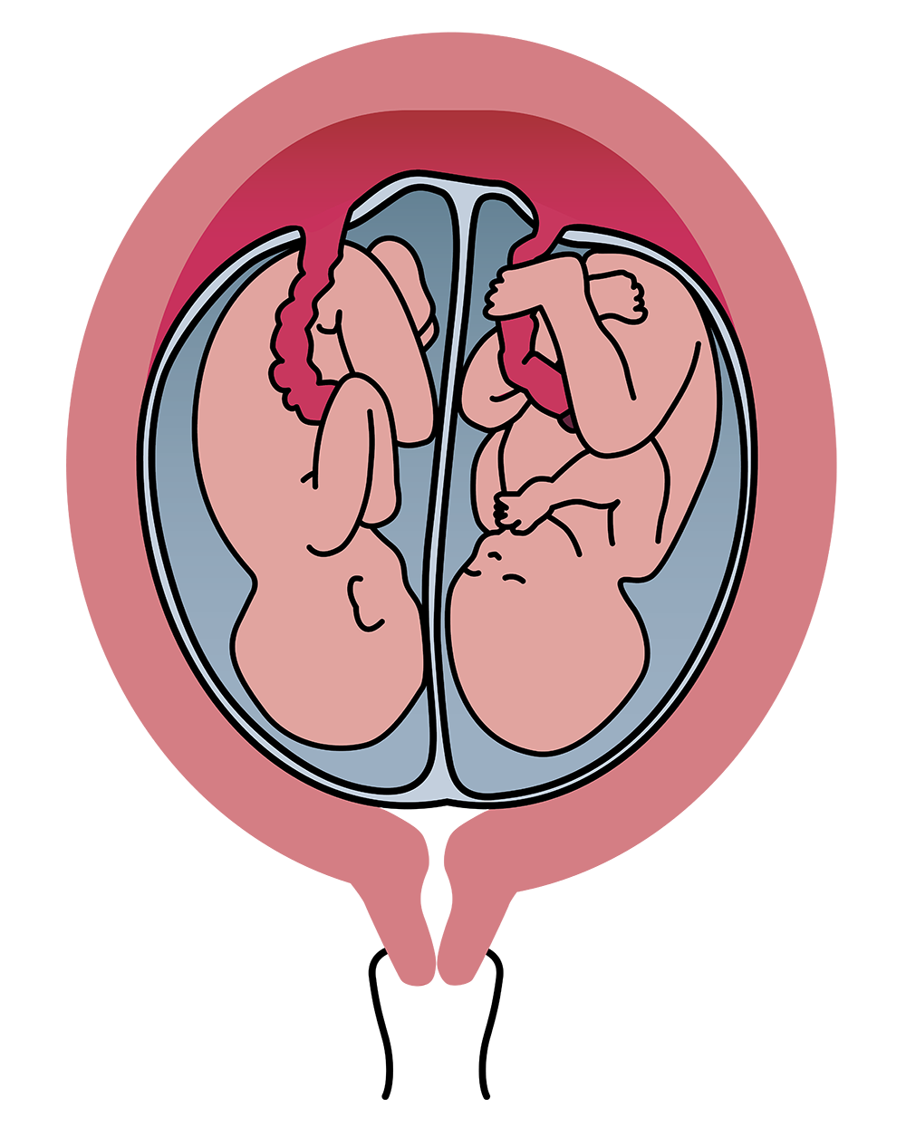 Illustration af monochoriske tvillinger, der deler moderkagen og den ydre fostersæk