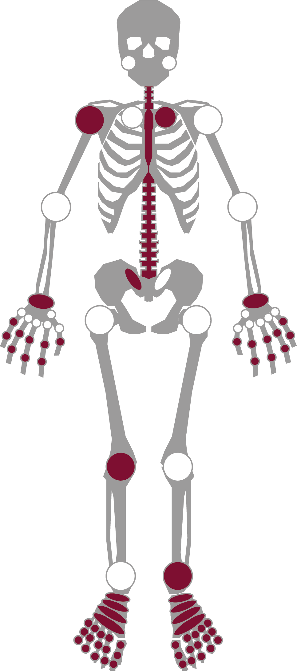 Grafisk illustration af ovenstående tekst med visning af de dele af kroppen, der typisk bliver ramt af psoriasisgigt