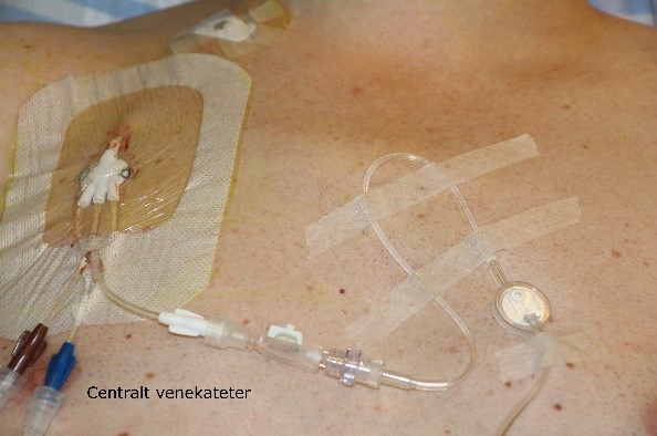fastgørelse af pumpe på centralt venekateter