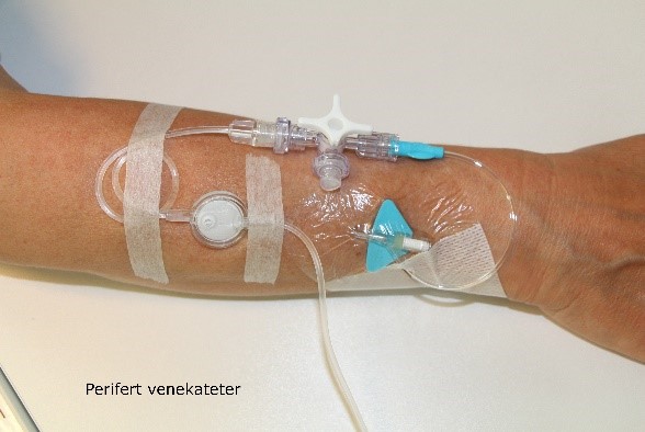 Fastgørelse af pumpe på perifert venekateter