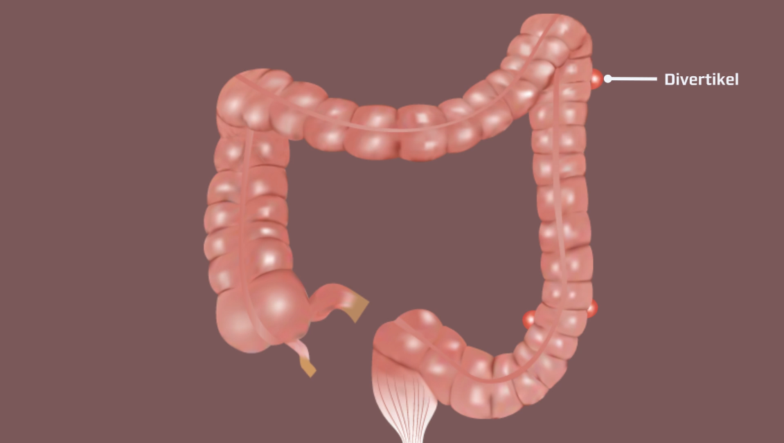 Divertikel.png