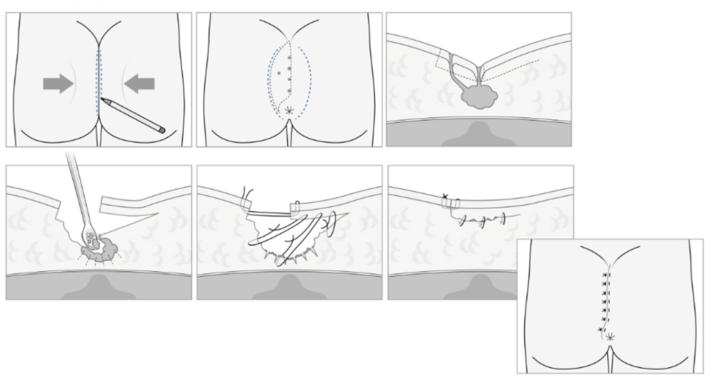 Illustration af en Bascoms kløft-løft operation