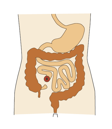 Grafik, der viser placeringen af en tyndtarmsstomi på maven