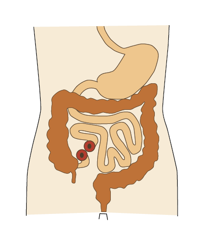 Grafik, der viser en loop-ileostomis placering på maven