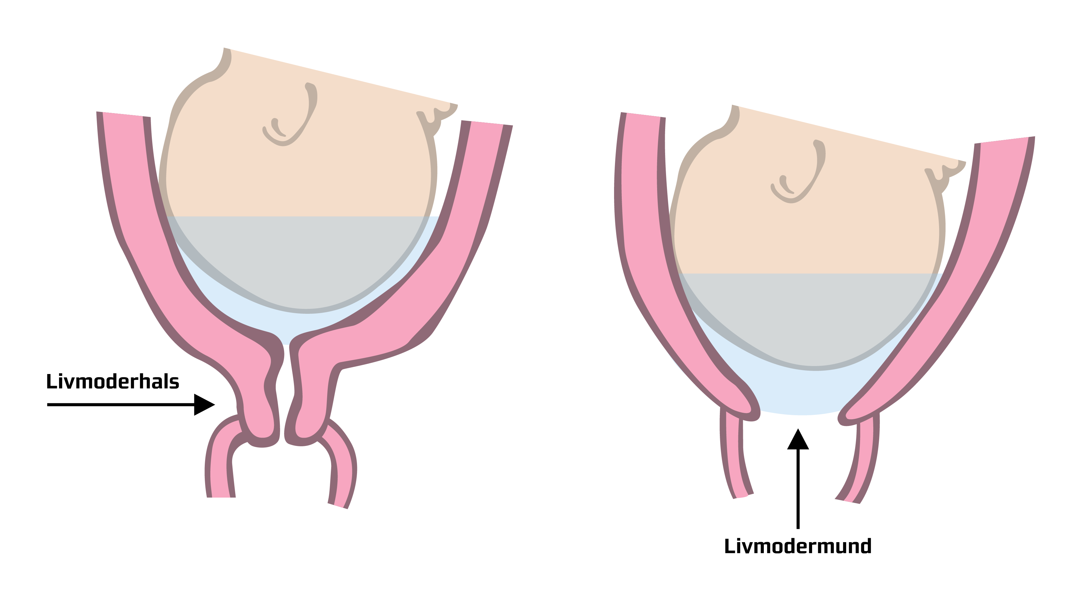 Her vises forskellen på "umoden" og "moden" livmoderhals/livmodermund.