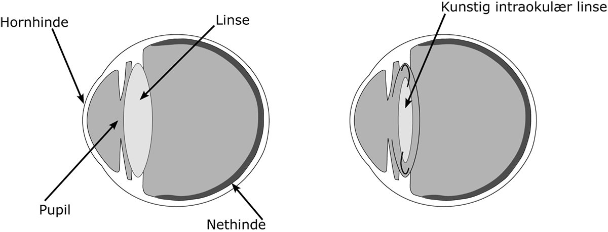 Tegnet tværsnit af et øje med den naturlige linse og et øje med den kunstige linse