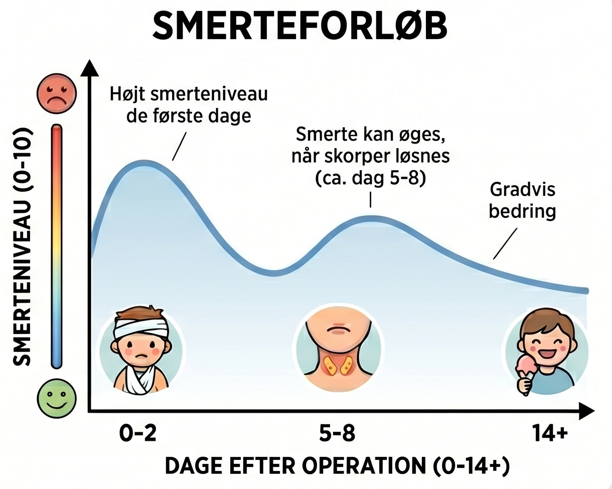Smerterne er st&aelig;rkest lige efter operationen. Derefter aftager smerterne. De vil dog typisk v&aelig;re st&aelig;rkere igen p&aring; 4. og 5. dagen.