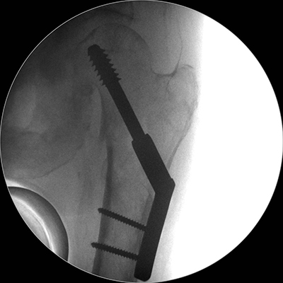 Røntgenbillede af hofte med glideskrue figur 2