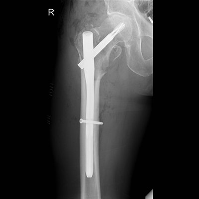 Røntgenbillede af hofte med marvsøm figur 3