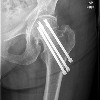 Røntgenbillede af hofte med 3 parallelle skruer figur 1