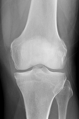 Røntgenbillede af knæ uden slidgigt