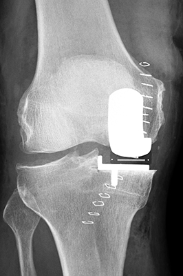 Røntgenbillede af knæ med Oxford-protese