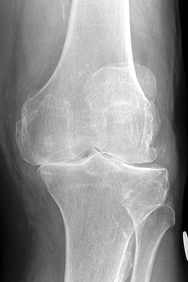 Røntgenbillede af knæ med slidgigt