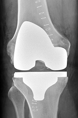 Røntgenbillede af knæ med helprotese