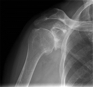 Ledprotese i skulder - røntgenbillede
