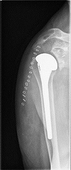 Ledprotese i skulder - røntgenbillede