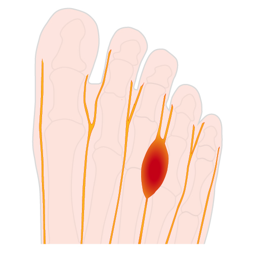 Tegning af Mortons neurom på en fod