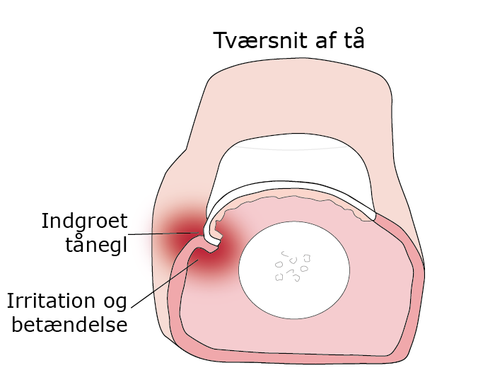 Operation af nedgroet negl - Regionshospitalet Randers Regionshospitalet Randers