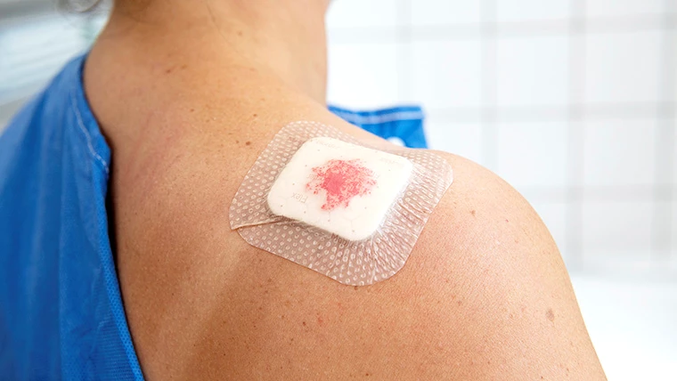 Plaster, der er ca. en tredjedel gennemsivet